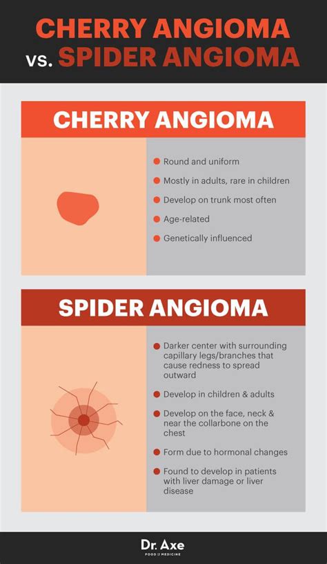 Cherry Angioma And Liver Disease Captions More