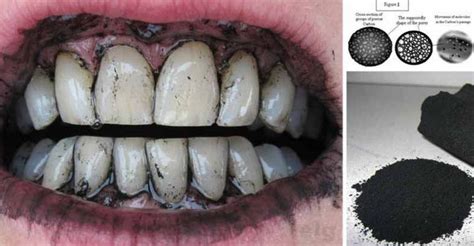 Vous aussi obtenez des dents blanches avec le charbon actif 12.000fcfa +la livraison gratuite dans tout le gabon. La Recette Pour Avoir Des Dents Blanches Instantanément ...