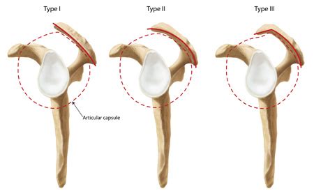With impingement syndrome, pain is persistent and affects everyday activities. Shoulder impingement syndrome - Ορθοπαιδικός Χειρουργός ...