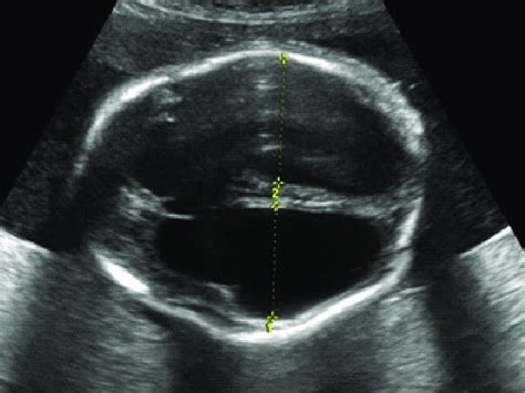 Cyst Lateral Ventricle Ultrasound