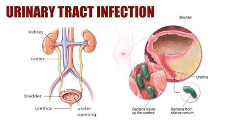 With neobladder reconstruction, you may have bloody urine after surgery. Urinary Tract Infection - How To Get Rid and Prevent ...
