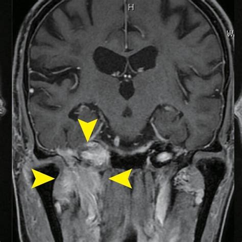 A T2 Weighted Magnetic Resonance Imaging Mri Of The Head Showing