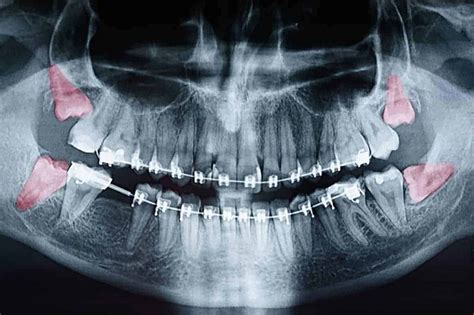 Wisdom Teeth Extractions In Dallas Tx White Rock Oral