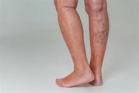 Leg Pain And Vein Disease Understanding The Link Prime Heart And