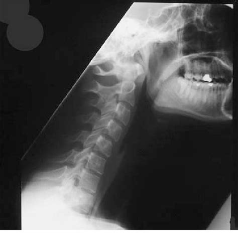 Lateral Cervical Spine X Ray Showing Loss Of Normal Cervical Lordosis