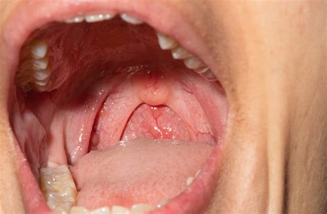 Throat Anatomy Tonsils