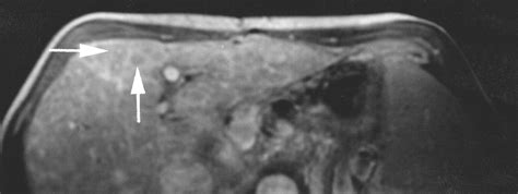 Primary Biliary Cirrhosis Mr Imaging Findings And Description Of Mr