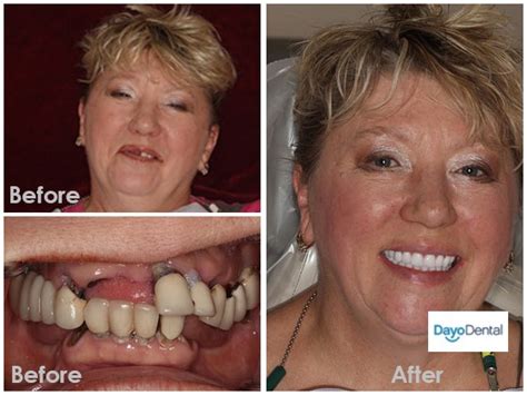 Denture Before And After Pictures Dental News Network