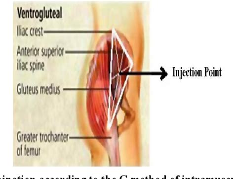 [pdf] using ventrogluteal site in intramuscular injections is a priority or a n alternative