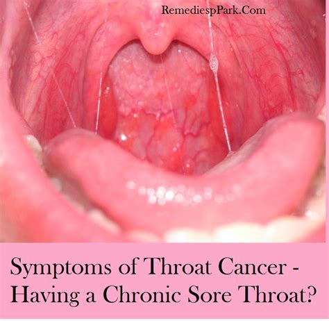 Do I Have Throat Cancer