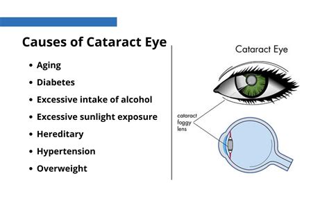Cataracts Infographics Disease Eyes Infographic Info