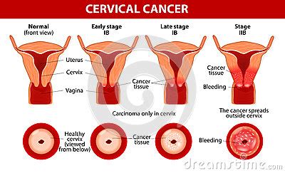 Cervical Cancer Carcinoma Of Cervix Vector Illustration CartoonDealer Com