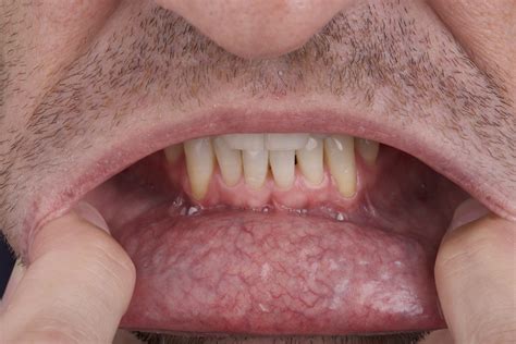 White Spots On Lips Cancer