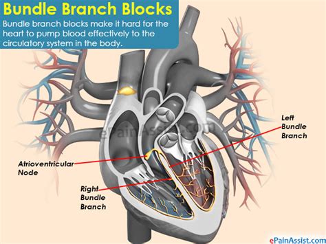 Bundle Branch Blockscausessymptomstreatmentcomplicationsrisk Factor