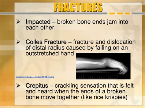 PPT - SKELETAL SYSTEM Fractures PowerPoint Presentation ...