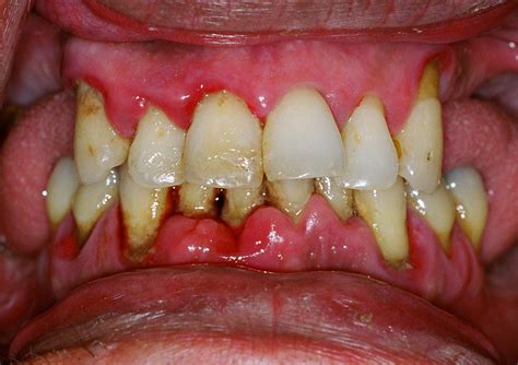 Early Signs From Gingivitis To Periodontal Treatment Precious Smile