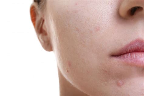 Whats The Difference Between Teenage And Adult Acne Dermatology Of