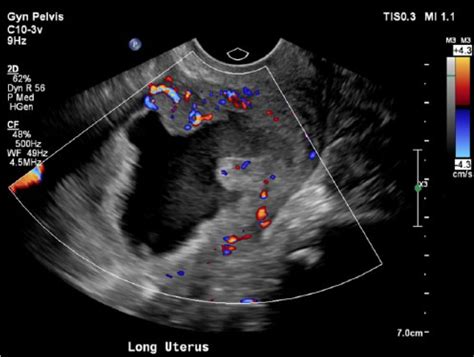 Sonographic Presentation Of Endometrial Carcinoma Stage I A Case Study