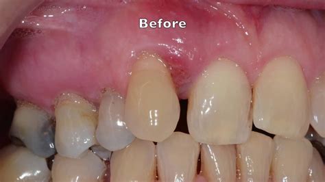 Treatment Of Severe Gum Periodontal Disease Youtube