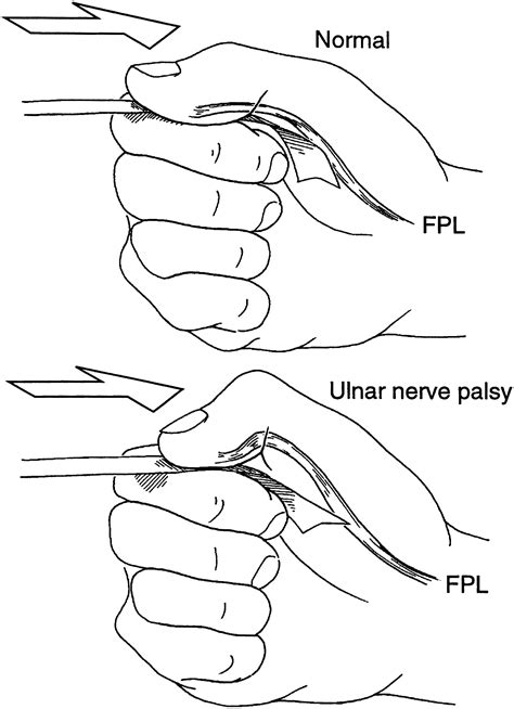 Ulnar Nerve Laceration And Repair Hand Clinics