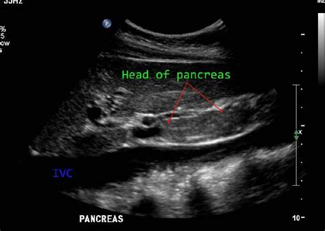I Hate This Sucker Sagittal Plane Bile Duct Sonography Cystic