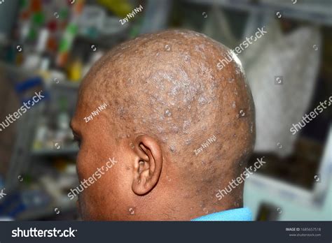Стоковая фотография 1685657518 Seborrheic Dermatitis Fungal Skin