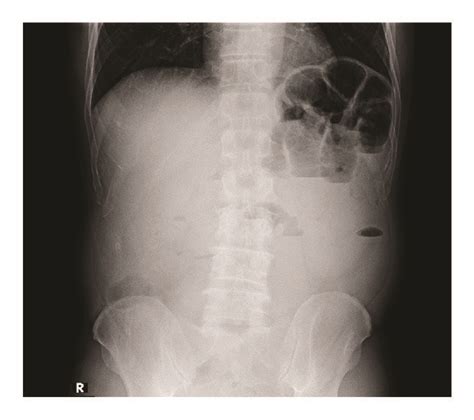 Abdominal Radiography Performed In Upright Position Revealed Distended
