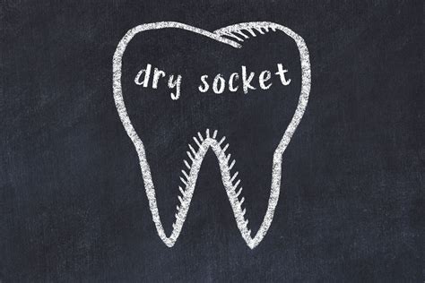 6 Tips For How To Treat A Dry Socket