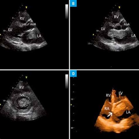 Transthoracic Echocardiography A Parasternal Long Axis View Systole