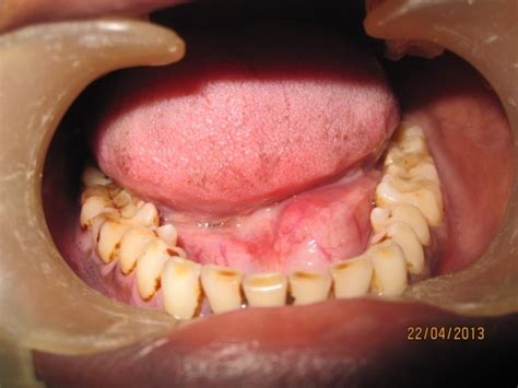 Floor Of Mouth Swelling Review Home Co
