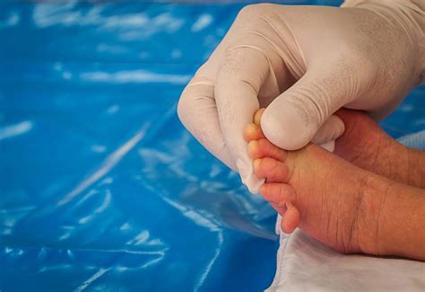 Baby Born With Extra Finger And Toes Polydactyly