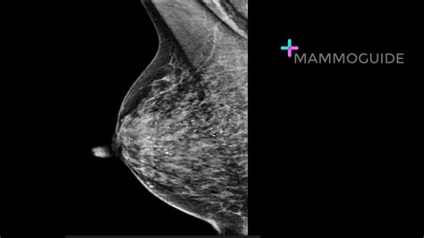 Breast Imaging Cases MAMMOGUIDE Learn Breast Imaging