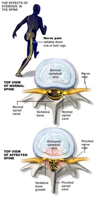 Spinal Stenosis Lumbar Region With Neurogenic Claudication Terisl