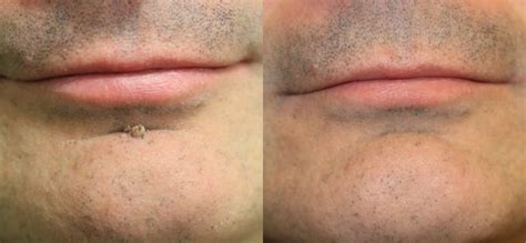 Chin Wart Removal Surgery Result Skin Surgery Laser Clinic