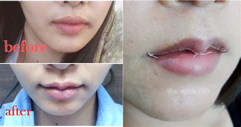 Lip Reduction Surgery In Asia Crazy How The Standards Of Beauty Can Be