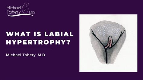 What Is Labial Hypertrophy Youtube