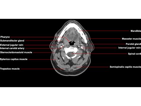 Anatomy of the muscular system. CT Neck Axial Anatomy | RADIOLOGYPICS.COM