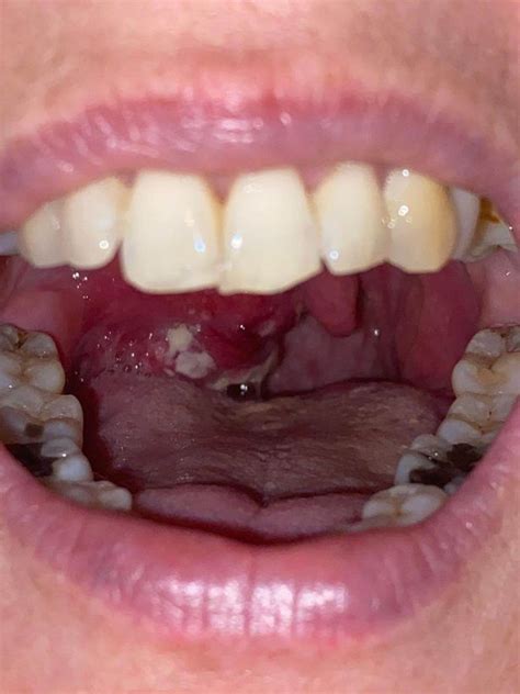 Mum Of Three Stunned When Her Sore Throat Turned Out To Be Tonsil