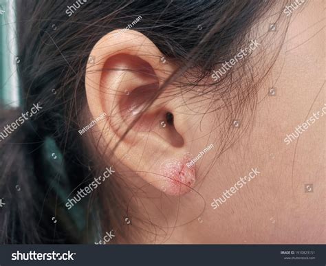 Closeup Ear Wound Caused By Piercing Stock Photo Edit Now 1910823151