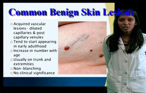 Dermatology Common Benign Skin Lesions Anatomy Guy