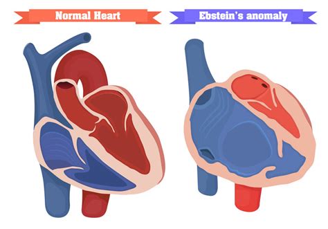 Congenital Heart Disease Symptoms And Treatment Pulse Cardiology