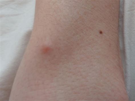 Treating Lumps Bumps And Benign Skin Lesions Dr Tanja Phillips Clinic
