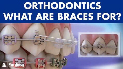How Braces Work Elements Of The Orthodontic Treatment And Its Role