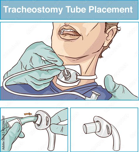 Tracheostomy Tube Placement Labeled Stock Illustration My Xxx Hot Girl