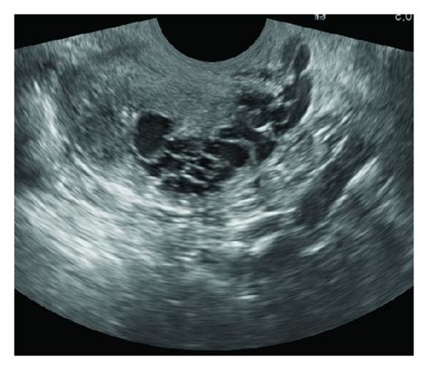 Uterine Vascular Malformation Presenting With Recurrent Vaginal