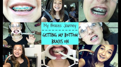 my braces journey getting my bottom braces on youtube