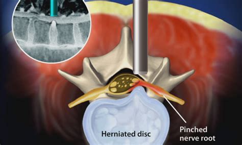 O Que A Discectomia Micro Endosc Pica Stephen P Courtney Md Ortopedic Spine Surgeon