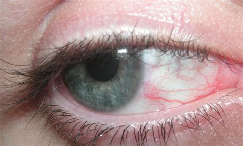 Red Spot On Eyes Causes And Treatment Healthspresso