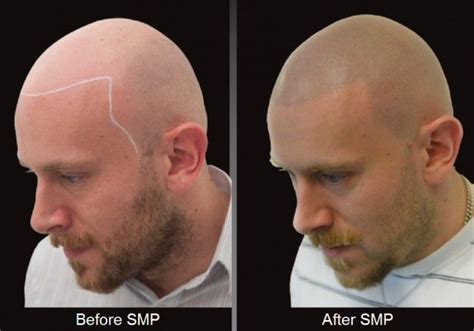 He shares his practice with dr. New York's HIS Hair Clinic fights baldness with needle and ...