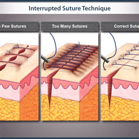 Interrupted Suture Technique Trialexhibits Inc